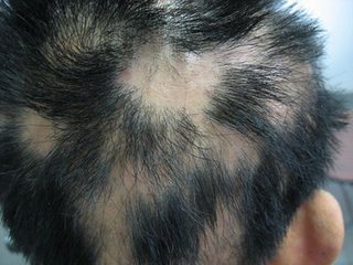 斑秃会给患者带来哪些危害呢？(图1)