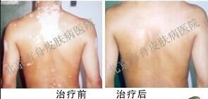 吴某康复案例(图1)