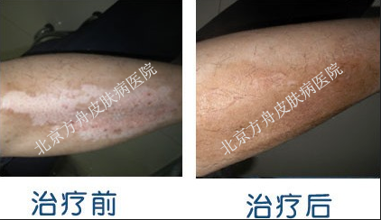 孙大爷康复案例(图1)