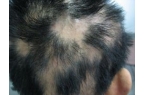 斑秃会给患者带来哪些危害呢？