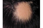 斑秃应该如何检查才能够确诊？