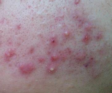 痤疮的治疗应注意什么?(图1)