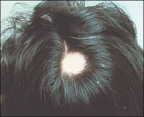 斑秃多久能长出头发呢?(图1)