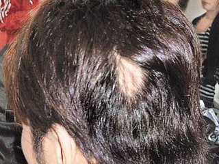 斑秃患者需要注意什么？(图1)