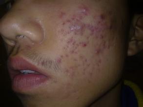 不同类型的痤疮的症状特点是什么?(图1)