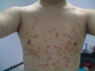 银屑病有哪四大常见的病因呢?(图1)