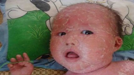 鱼鳞病具体会有什么危害呢?(图1)