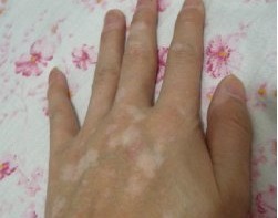 白癜风给患者带来什么样的危害?(图1)