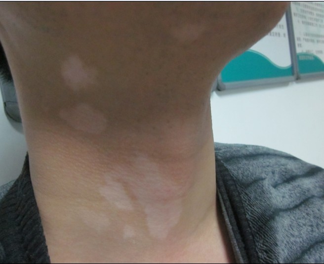 白癜风给患者的危害是什么?(图1)