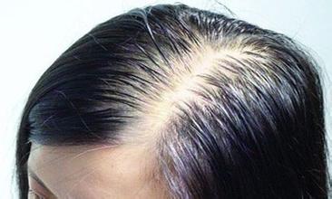 王女士脱发康复案例(图1)