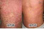 汪先生康复案例