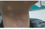 白癜风早期治疗效果是不是很好?