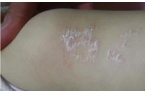 儿童牛皮癣如何进行治疗呢?