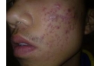 不同类型的痤疮的症状特点是什么?