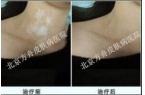 刘女士康复案例