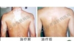 吴某康复案例
