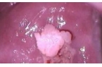 如何来预防尖锐湿疣的发生?