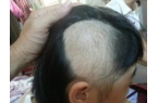 斑秃介绍