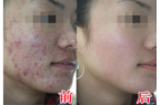 黄玲玲康复案例